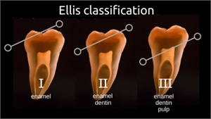 Ellis classification tooth fracture