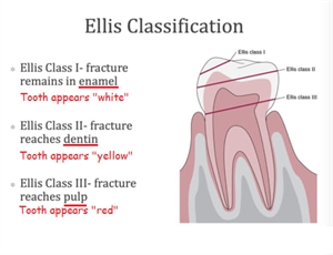Ellis classification for enamel and dentine tooth fracture