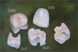 Difference between dental crown, veneer, inlay and onlay