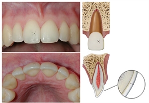 Tooth enamel infraction - weakening and micro cracks in the enamel structure