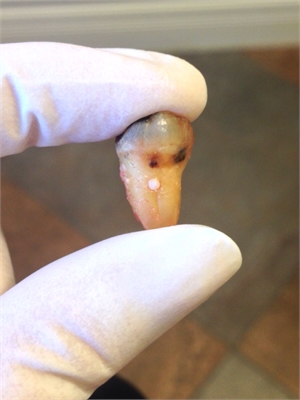 Enamel pearl located on this extracted tooth