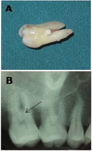 Enamel pearl on a tooth and radiograph