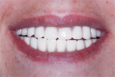 Dental Iimplants