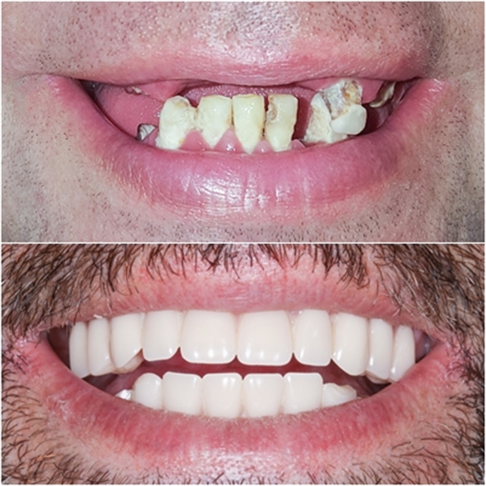 Teeth in a day- Dental Implants