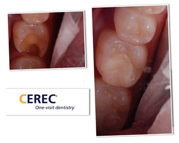 CEREC Tooth Restoration