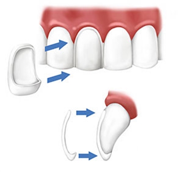 Dental Veneers - Batavia Dentist