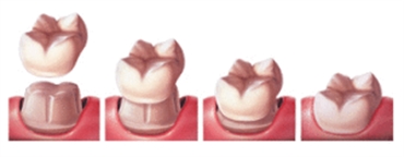 Dental Crowns Bountiful- naperville cosmetic dentistry