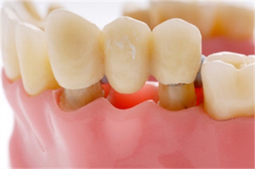 Dental Bridge - dentist naperville