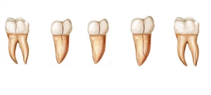 What is VRF (vertical root fracture) and cracked tooth syndrome?