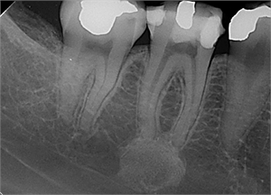 Condensing Osteitis on radiograph