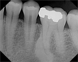Condensing osteitis appears on x-ray as area with higher bone density. Infection is fought by the body, which creates newly formed bone. This can be attributed to a strong immune system