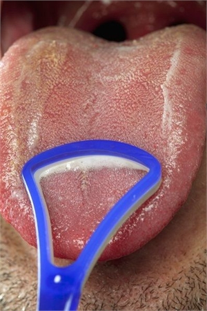 Tongue scraper removes plaque from the tongue fissures and surface. 