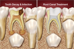 Root canal treatment on baby teeth