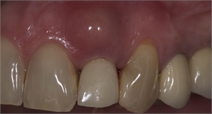 Dental granuloma over crowned tooth. Swelling and redness is present in the mouth