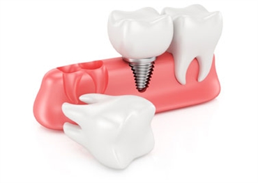 Dental Implants Mt Prospect