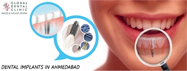  Everything You Ought To Know About Dental Implantation Services