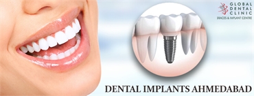 Is Dental Implant Treatment A Safe Way To Beautify Smile