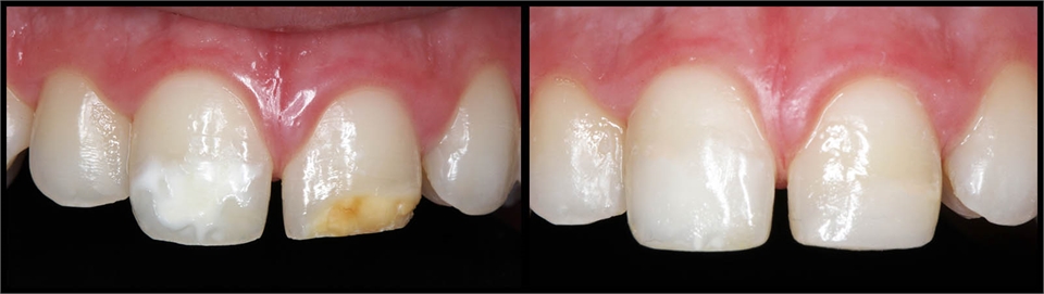 Fillings Before And After 