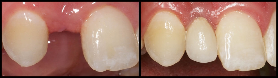 Front Tooth Implant Before And After