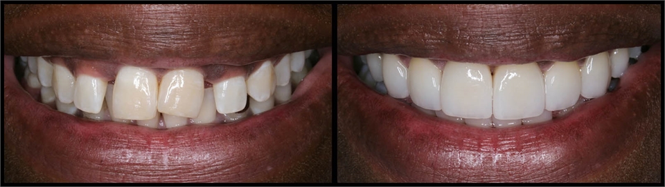 Gum Lift Veneers Before And After