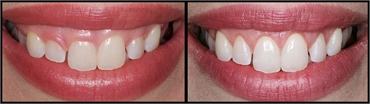 Gum Lift Before And After