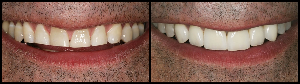 Veneers Before And After