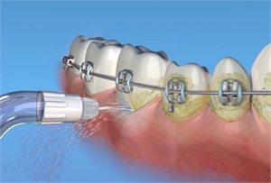 Removing plaque around braces with a water pick
