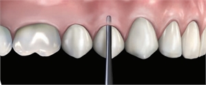 Syndesmotomy of the tooth is the destruction of the periodontal ligaments which connect the tooth roots to the alveolar socket. Syndesmotomy is part of the tooth extraction process