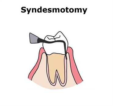 Syndesmotomy of tooth - what is this?