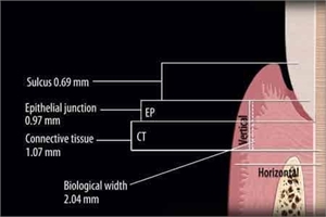 Dental biological width