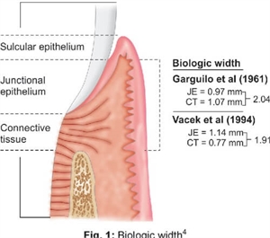 Tooth biological width illustration