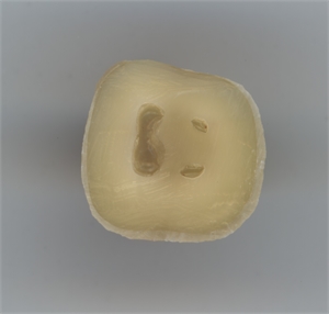 Pulp horns - anatomy of the dental pulp chamber shown in trans-sectional view on a molar tooth