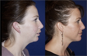 Chin augmentation and Genioplasty