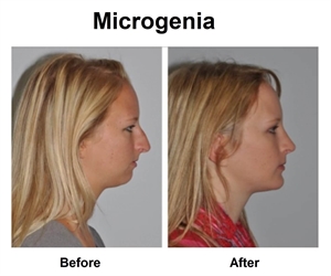 Microgenia is a condition of abnormally small chin