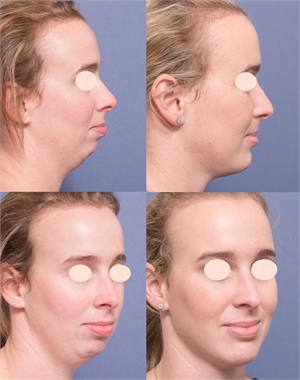Genioplasty procedure changes the shape of the chin and the facial profile