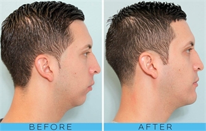 Chin genioplasty - before and after the surgical procedure