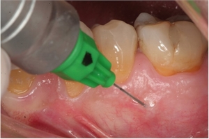 Intraosseous dental injection is a tooth aneasthetic inserted within the bone