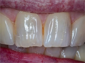 Teeth with lines in it