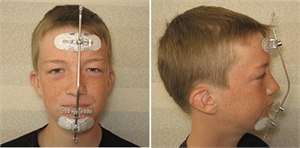 Headgear in orthodontics - facial and profile view