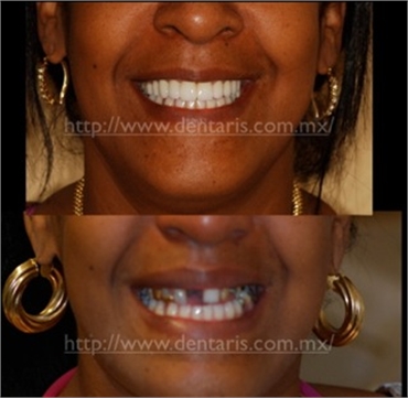 Dental Implants in Cancun