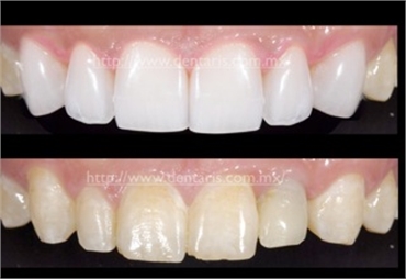 Cosmetic dentistry in Cancun 