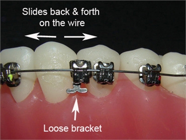 What to do when you have a loose dental bracket