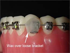 Orthodontic wax can be used to secure the dental bracket and avoid soft tissue damage