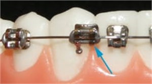 Loose orthodontic bracket