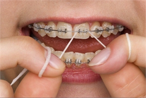 How to floss with braces on?
