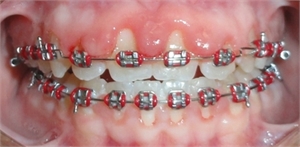 Gingivitis due to poor flossing and brushing around braces