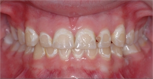 Tooth decay due to poor flossing and brushing around brackets