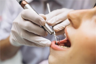 Facts That You Should Know About Root Canal Therapy