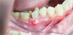 What is a dental fistula?