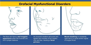 Orofacial myofunctional disorders